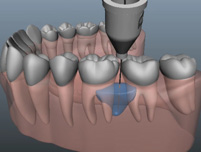 Lancy Dental Centre - Anästhesie