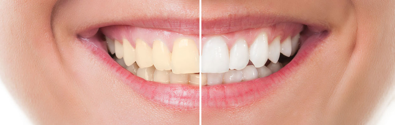 Centre dentaire Champel - Teeth whitening