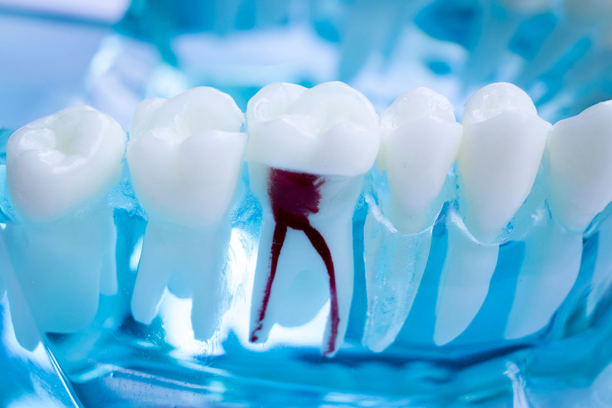 Centre dentaire Lancy - Tratamento de Raiz Dentária