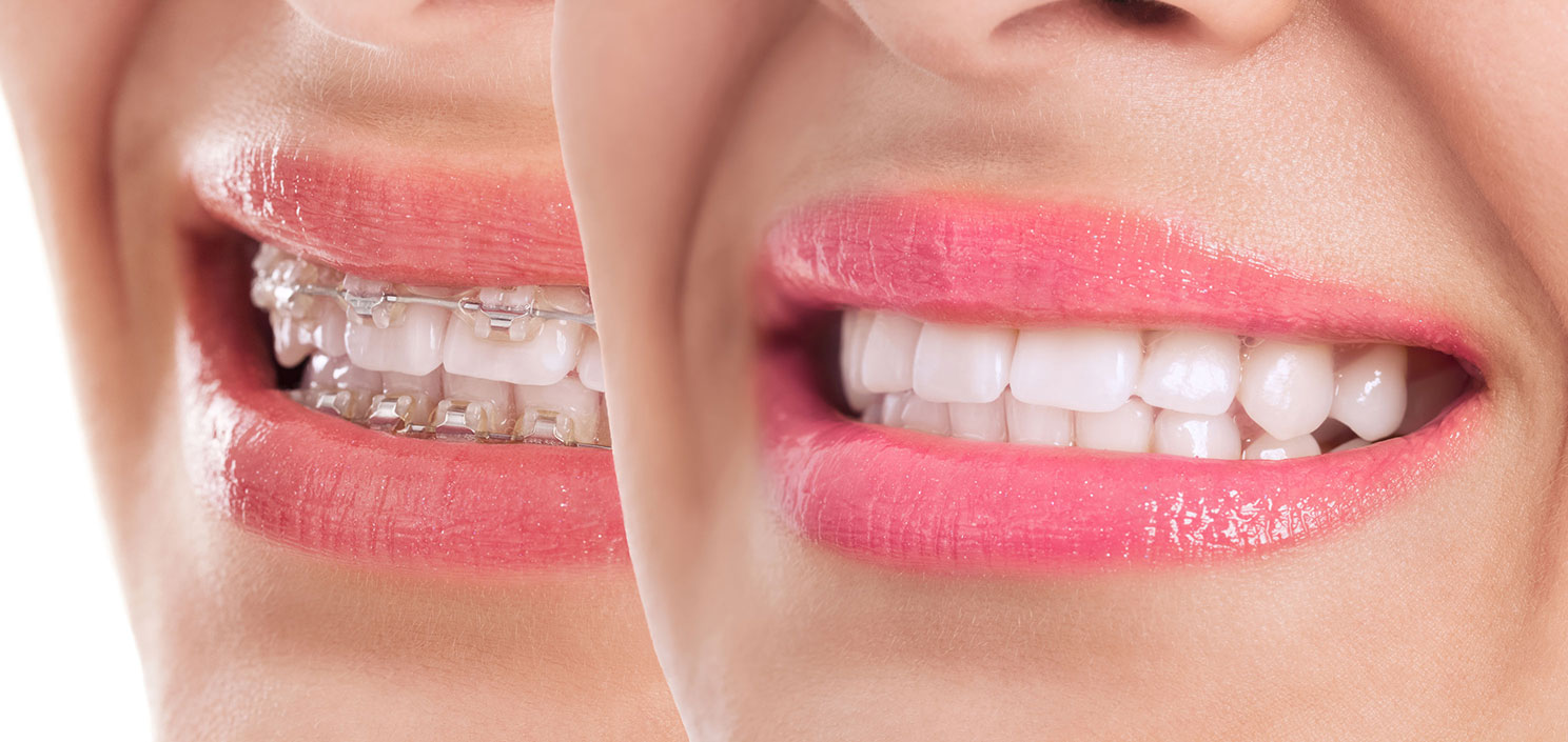 Centre dentaire Lancy - Orthodontie Adulte