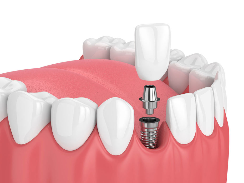 Centre dentaire Lancy - Implants dentaires