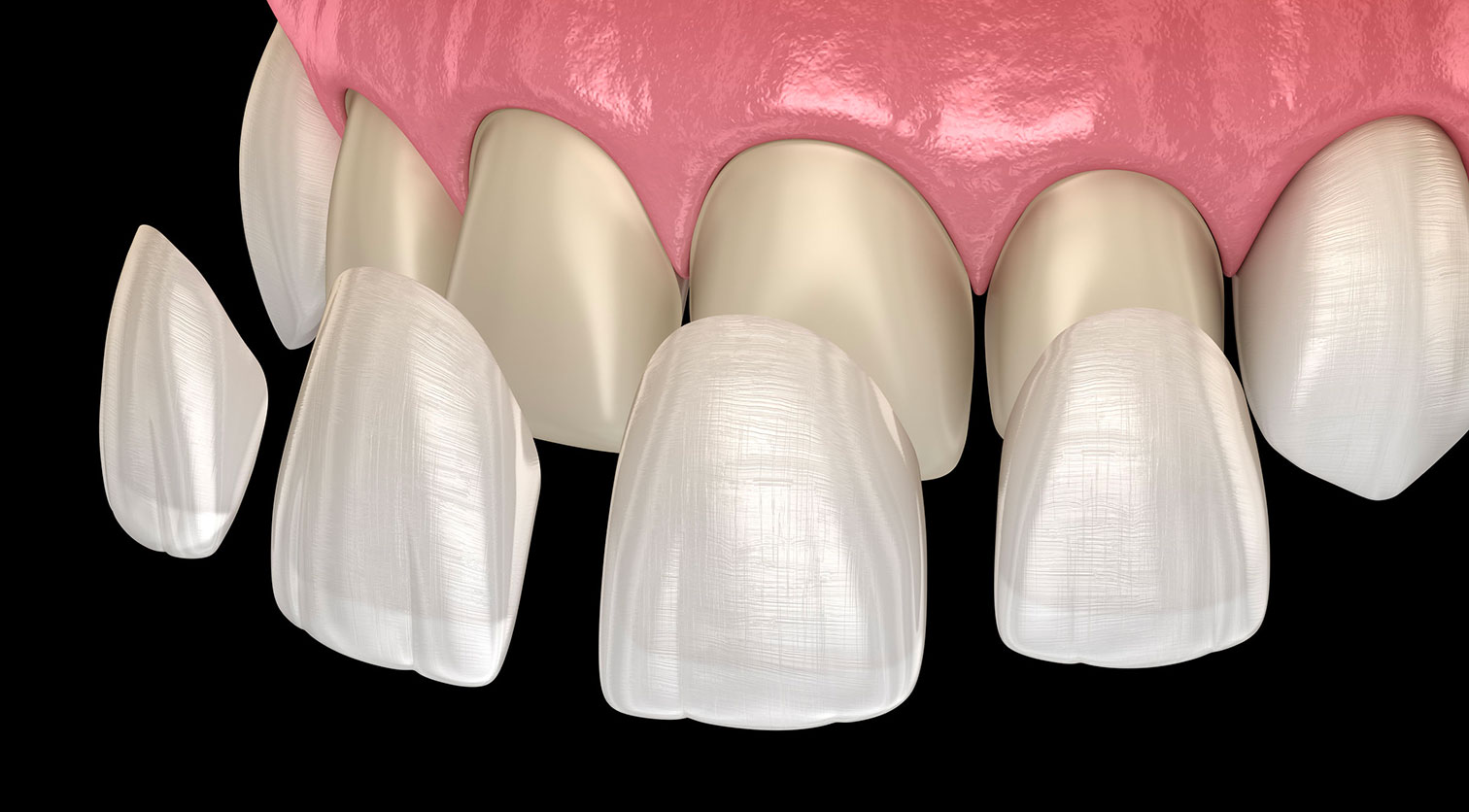 Lancy Dental Centre - Zahnärztliche Verblendschalen