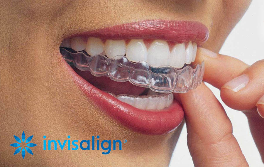 Centro dental Lancy - Invisalign