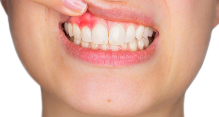 Lancy Dental Centre - cuidados com a gengiva
