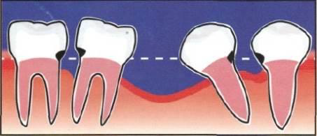 зубные имплантаты - 1
