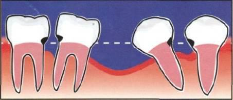 dental implants - 1