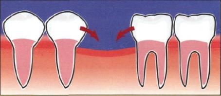 los implantes dentales
