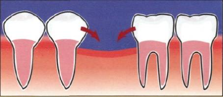 implantes dentários