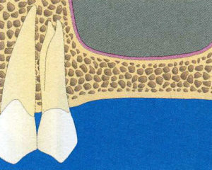 Patrón de sinusitis para el injerto y la regeneración de huesos