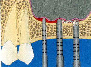 Schéma de Sinus pour la greffe et régénération osseuse2