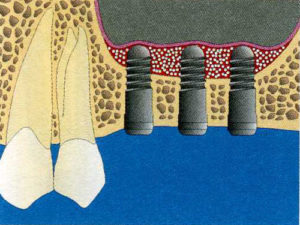 Sinusmuster für Knochentransplantation und -regeneration3