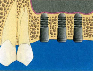 Sinusmuster für Knochentransplantation und -regeneration4