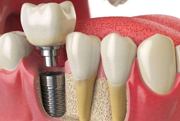 Implantes dentários - tecnologia odontológica