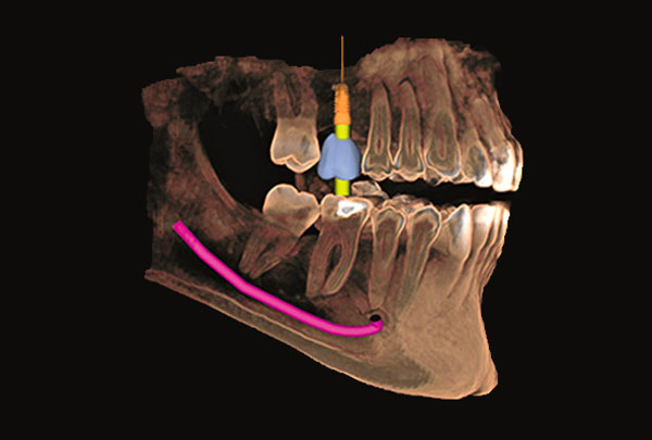 Radiología 3D en el Centro dentaire champel