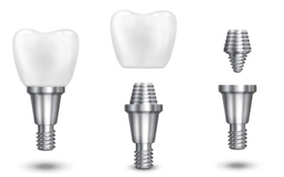 implant dentaire à Genève