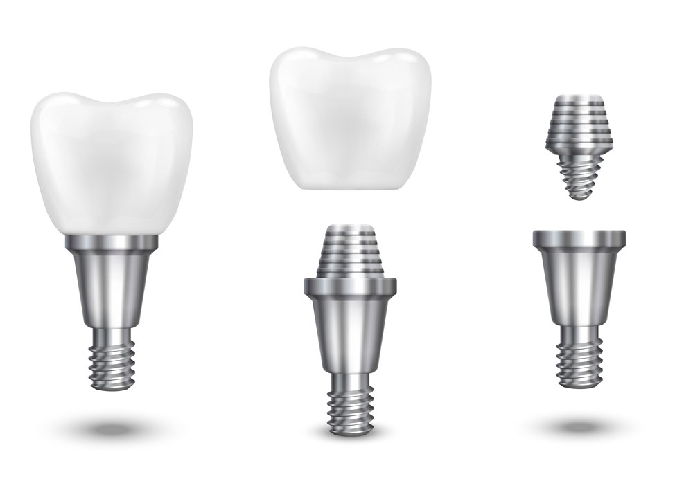 dental implant in Geneva