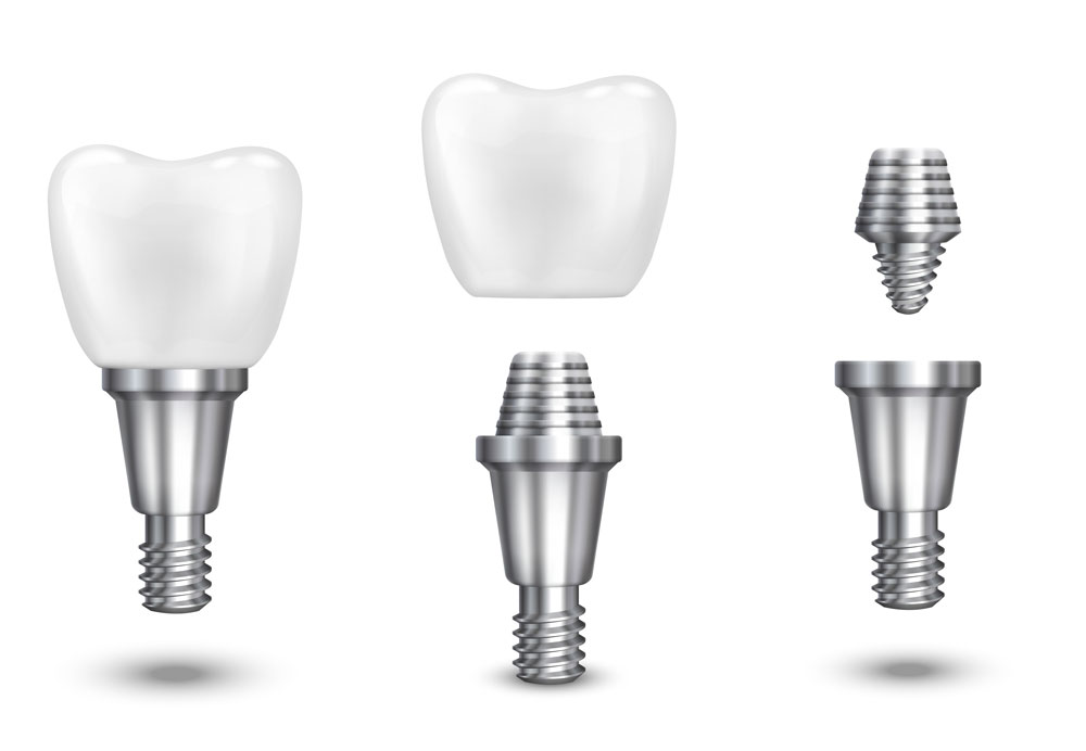 implantes dentales en Ginebra