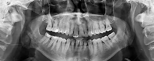 Radiografia panorâmica de adultos