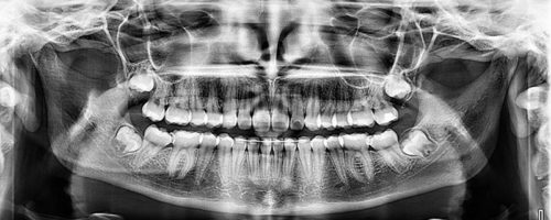 Radiographie Panoramique Enfants